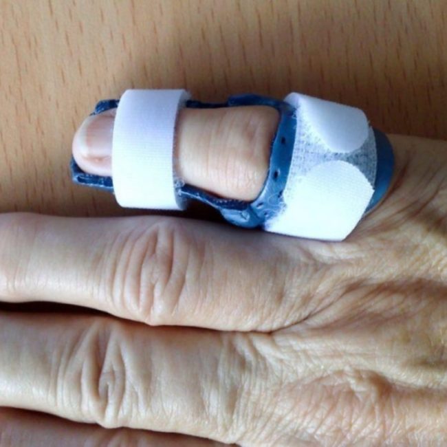 Orthèses du membre supérieur | Bigorre Orthopédie